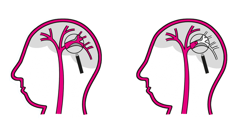 Herseninfarct - Patiëntenfolder - Erasmus MC